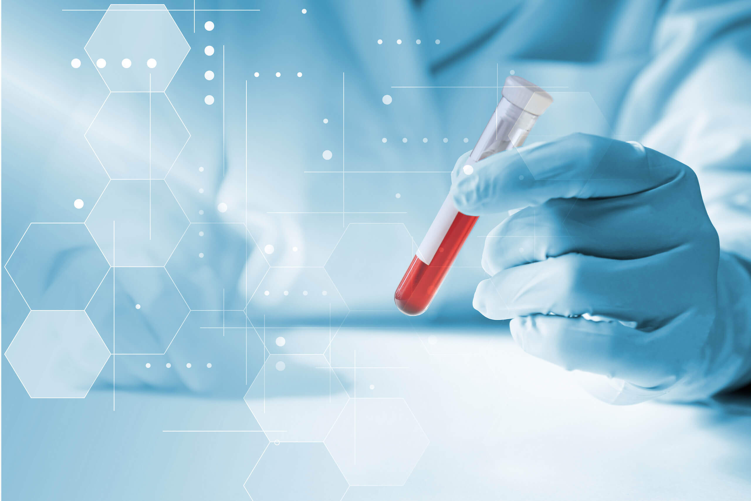 med4you_vitalstofftherapie_00004 Person mit blauen Handschuhen hält eine Blutprobe in der Hand